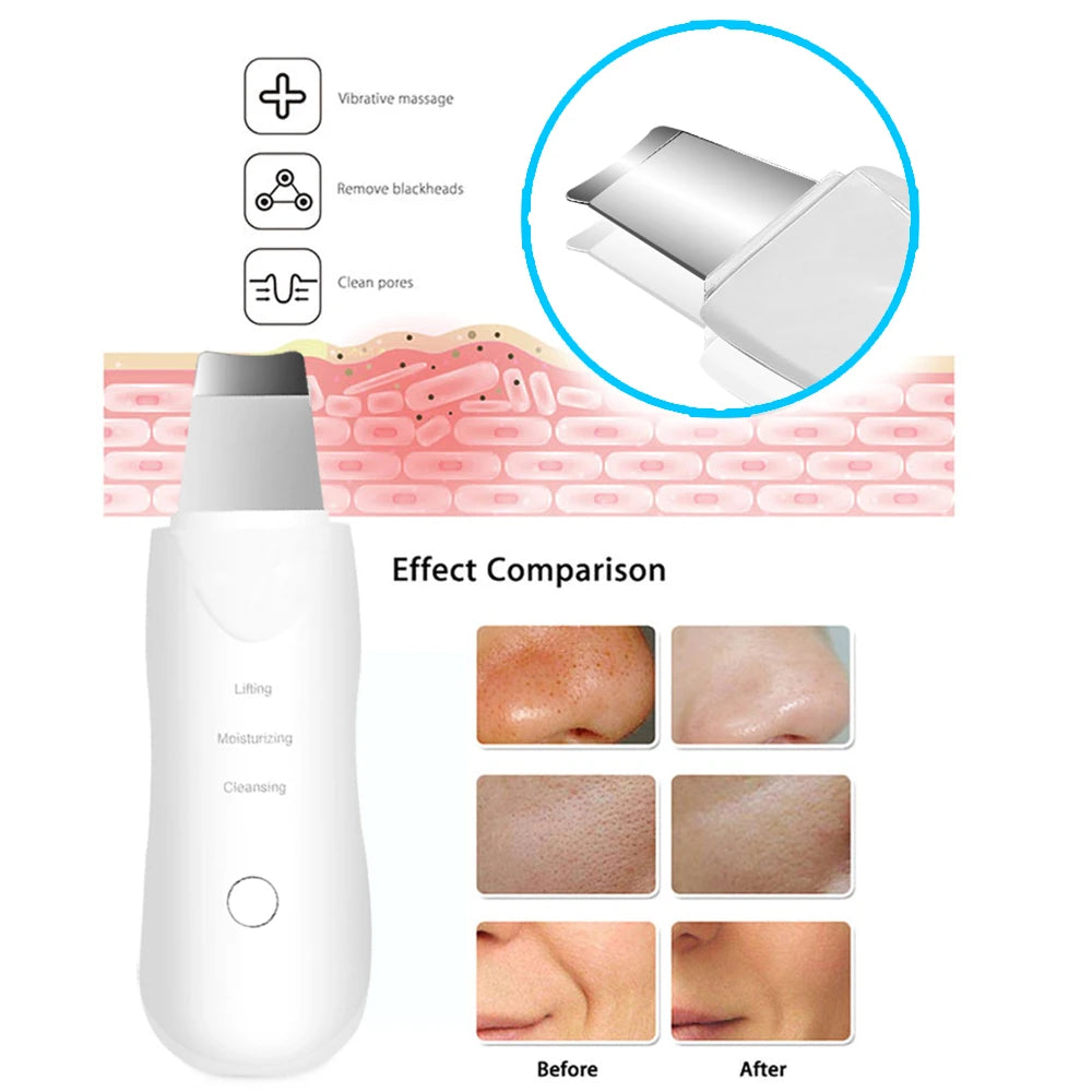 Ultrasonik Skin Scrubber
